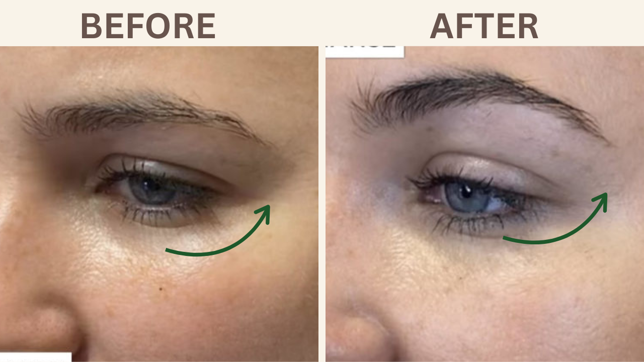 Brow Lift Botox