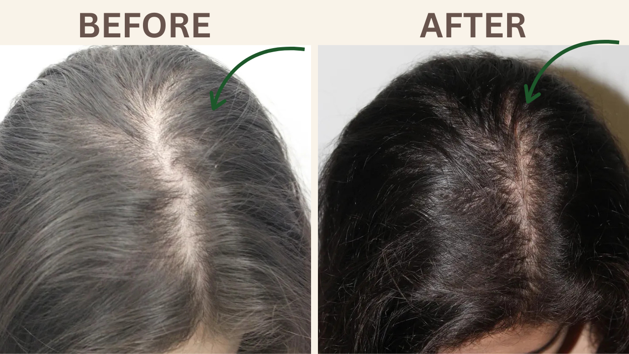 PRP Hair Restoration