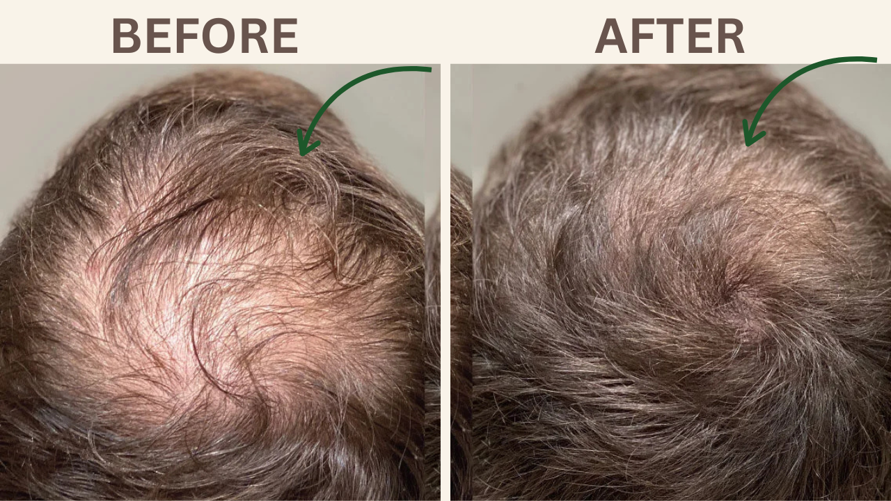 PRP Hair Treatment