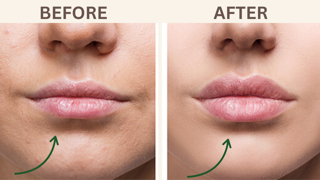 Lip Filler