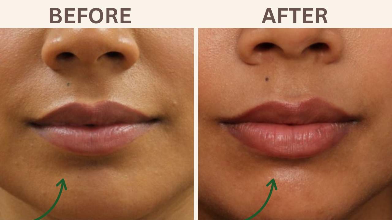 Lip Filler