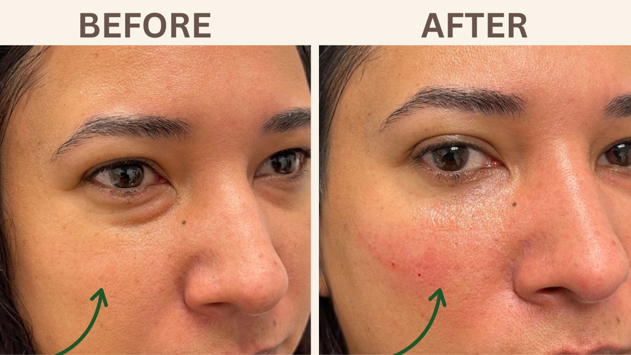 Hollow Eyes Filler