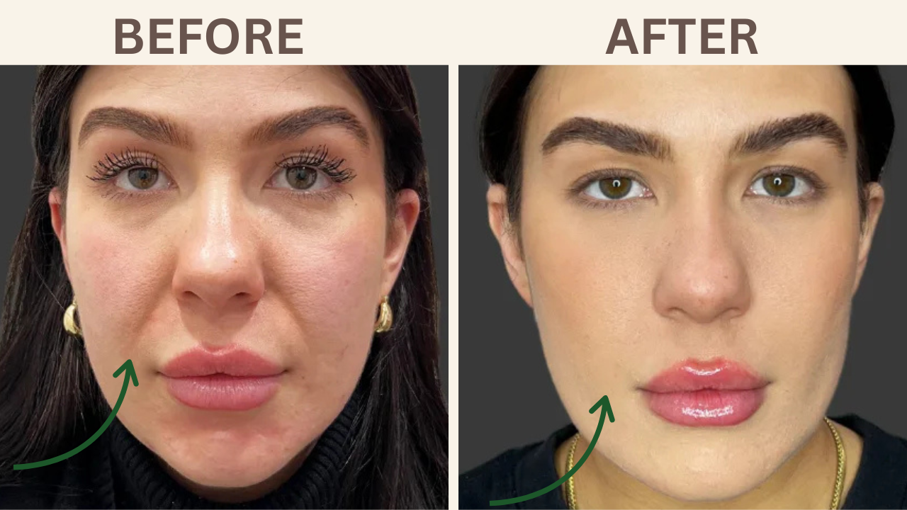 Nasolabial Folds (smile lines) Filler
