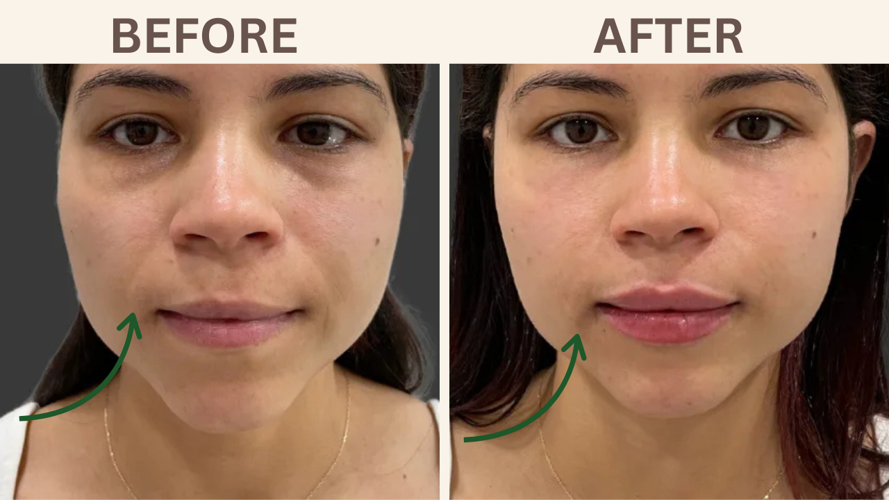 Nasolabial Folds (smile lines) Filler