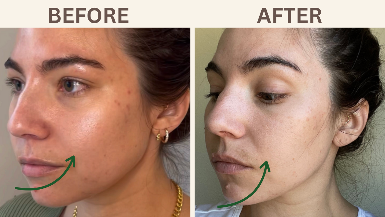Cheek Filler