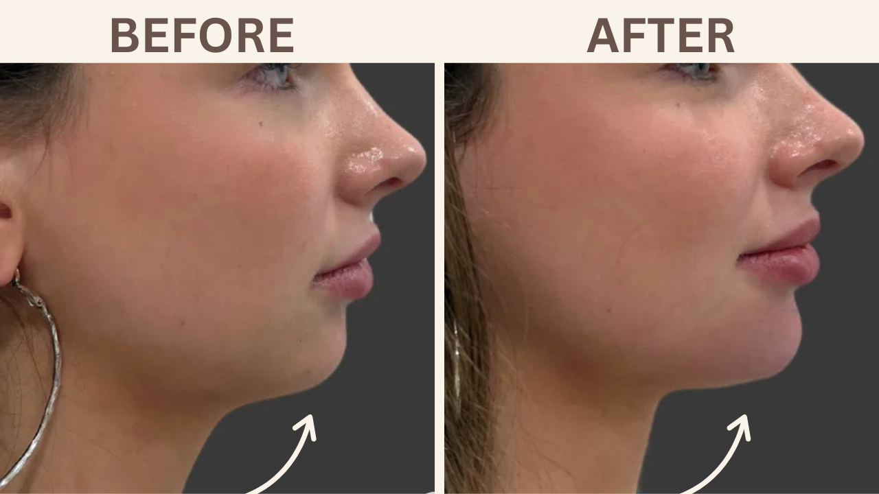 Chin Filler