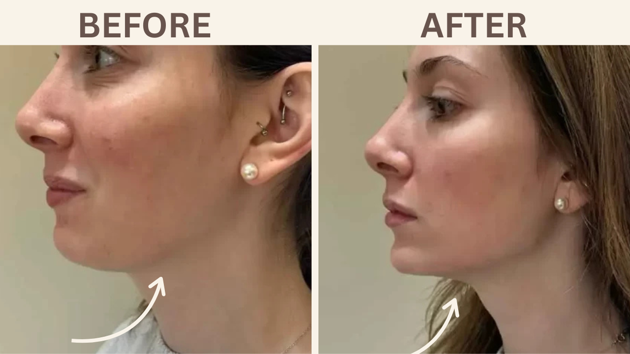 Jawline Filler