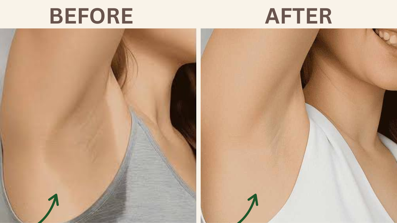 Underarm Sweat (Hyperhidrosis)