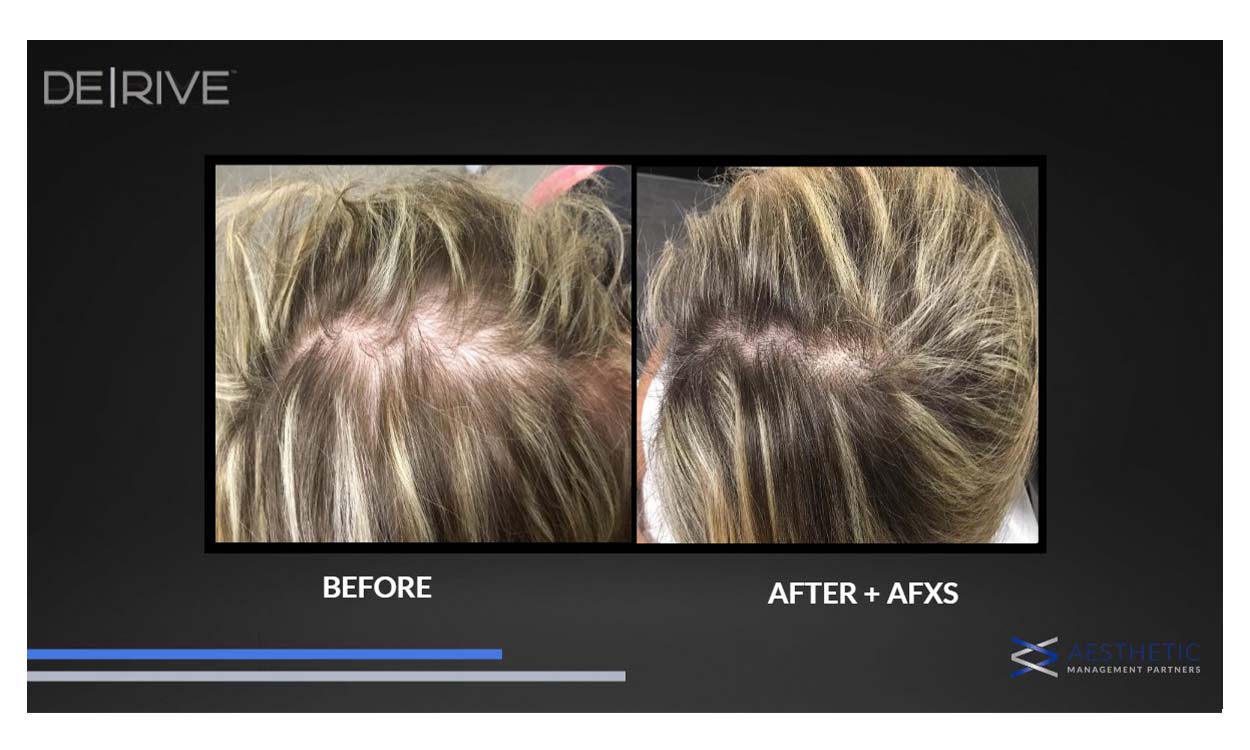 Hair restoration before and after result 2