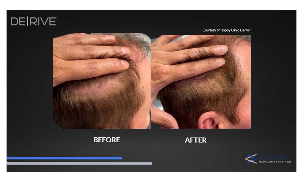 Hair restoration before and after result 4